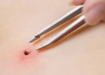 Yaz aylarının kabusu geri döndü: Keneden korunmanın basit ama etkili yolları neler?